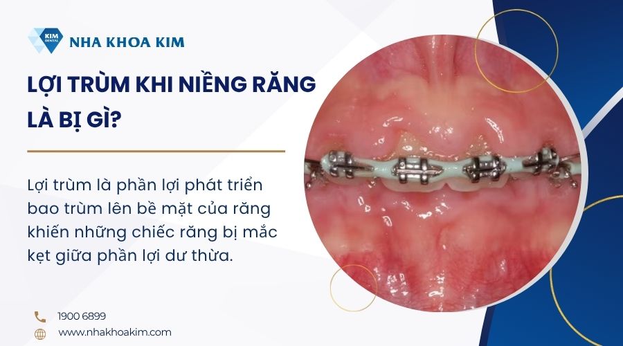 Lợi trùm khi niềng răng là bị gì?