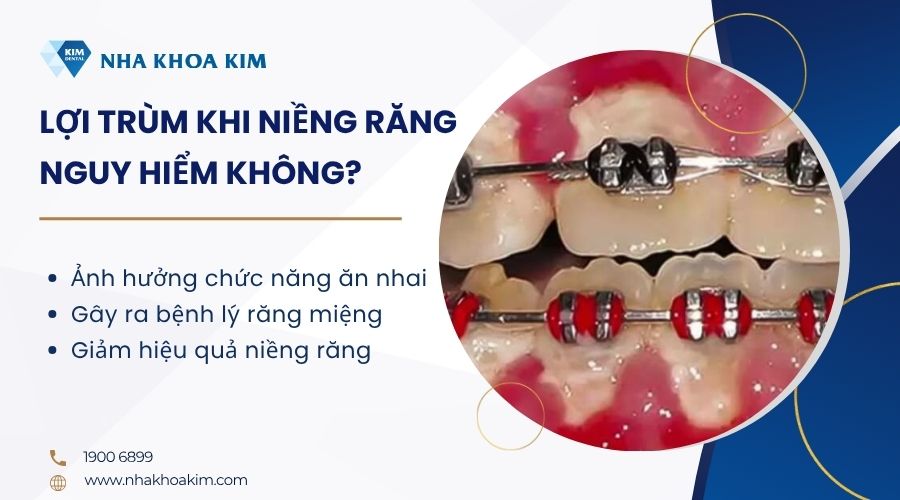 Lợi trùm khi niềng răng nguy hiểm không?