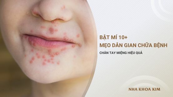 Bật mí 10+ mẹo dân gian chữa bệnh chân tay miệng hiệu quả