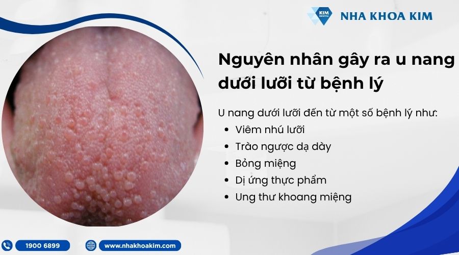 Nguyên nhân bị u nang dưới lưỡi do các bệnh lý