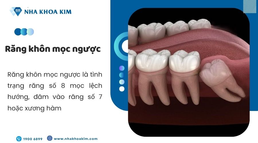 Răng khôn mọc ngược