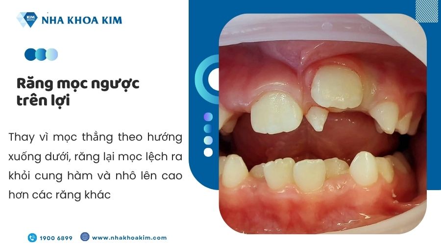 Răng mọc ngược trên lợi