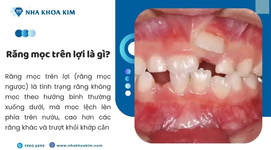 Răng mọc trên lợi là gì?