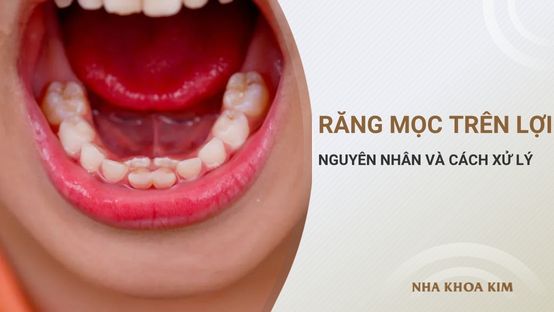 Răng mọc trên lợi: Nguyên nhân, dấu hiệu nhận biết và cách xử lý