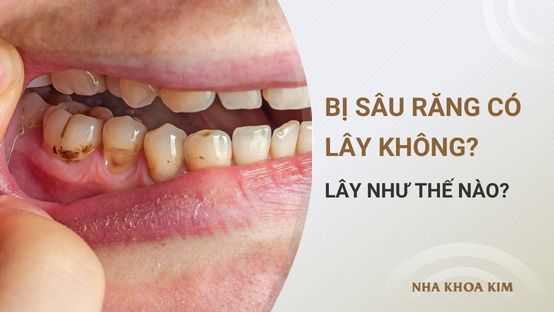 Bị sâu răng có lây không? Lây như thế nào?