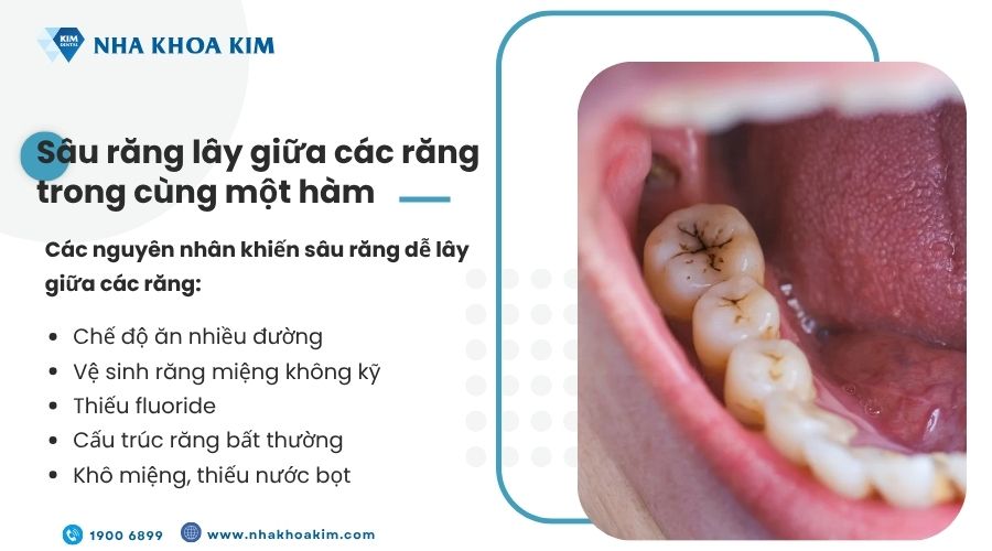 Sâu răng lây giữa các răng trong cùng một hàm