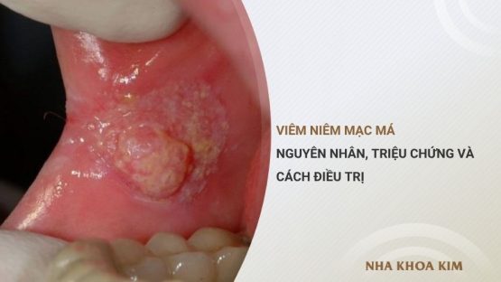 Viêm niêm mạc má: Nguyên nhân, triệu chứng và cách điều trị