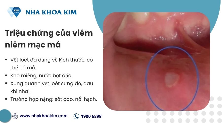 Triệu chứng của viêm niêm mạc má