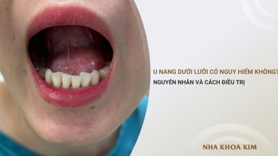 U nang dưới lưỡi có nguy hiểm không? Nguyên nhân, cách điều trị