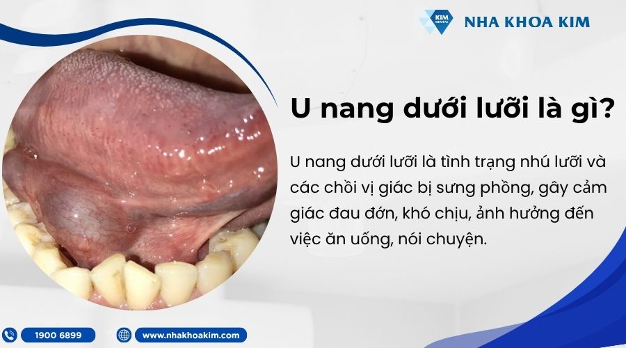 U nang dưới lưỡi là gì?