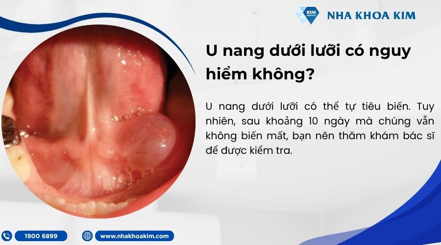 U nang dưới lưỡi có nguy hiểm không