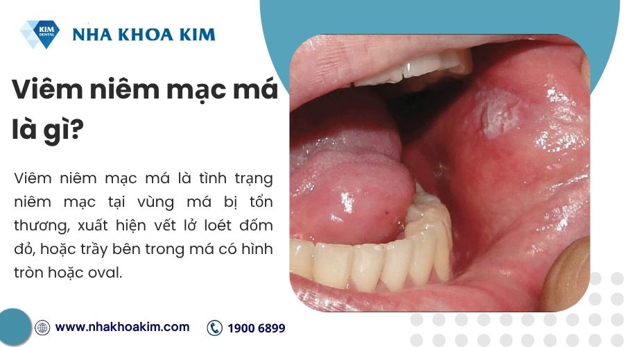 Viêm niêm mạc má là gì?