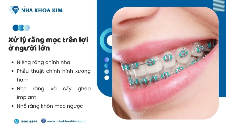 Xử lý răng mọc ngược ở người lớn