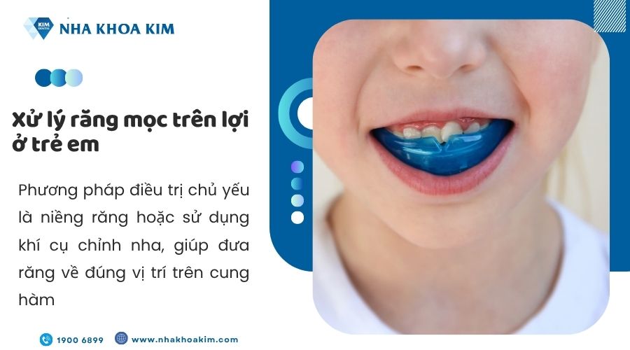 Xử lý răng trẻ mọc lệch