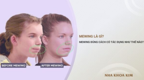 Mewing là gì? Mewing đúng cách có tác dụng như thế nào?