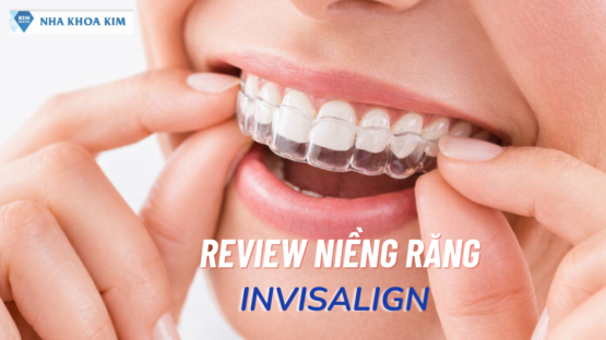 Review Niềng Răng Invisalign - Sự Lựa Chọn Tuyệt Vời Cho Bạn