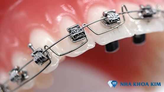 [Giải đáp] Dây cung niềng răng quan trọng như thế nào?