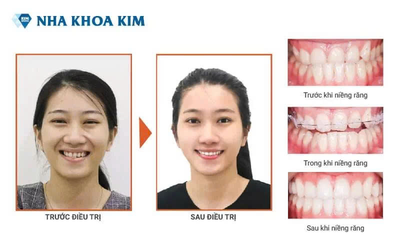 Tầm ảnh hưởng của dây cung nên quá trình niềng răng