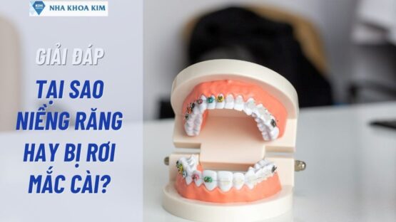Giải Đáp Thắc Mắc: Tại Sao Niềng Răng Hay Bị Rơi Mắc Cài?