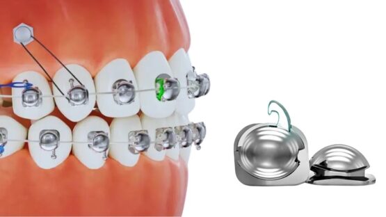 Niềng răng mắc cài cánh cam giá bao nhiêu? - Bảng giá mới nhất