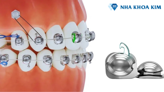 Niềng răng mắc cài cánh cam giá bao nhiêu? – Bảng giá mới nhất