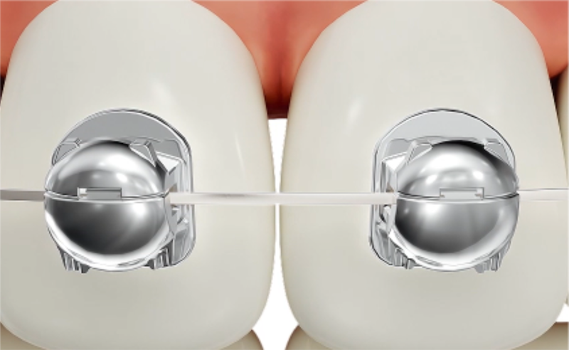 Cấu tạo niềng răng mắc cài cánh cam