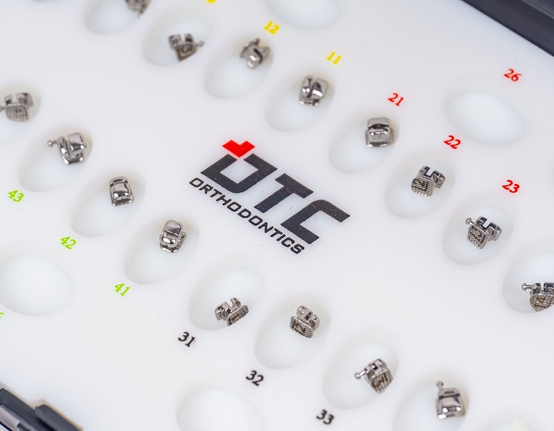 Lưu ý khi niềng răng mắc cài cánh cam