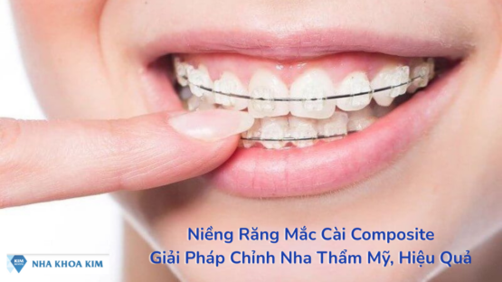 Niềng Răng Mắc Cài Composite – Giải Pháp Chỉnh Nha Thẩm Mỹ