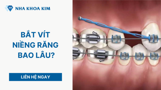 Bắt vít niềng răng bao lâu để đảm bảo thẩm mỹ?