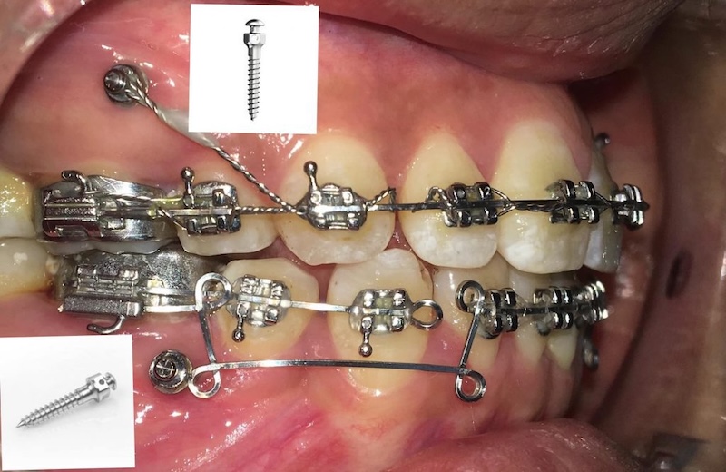 Công dụng của cắm minivis niềng răng