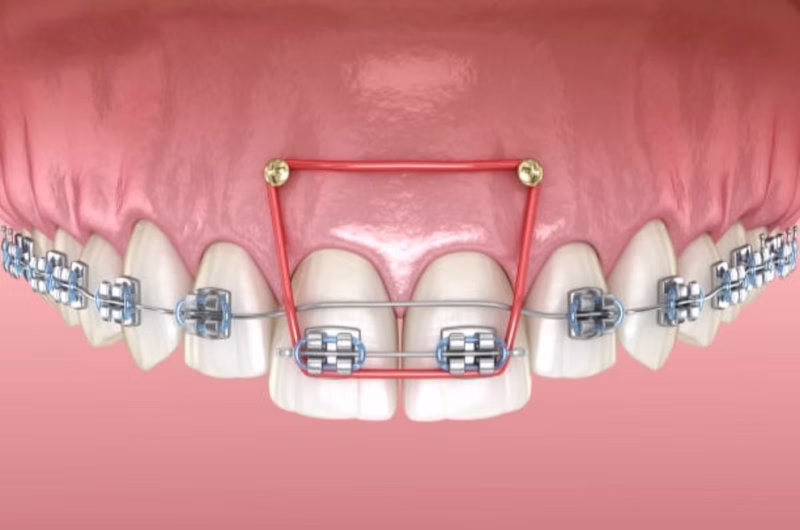 Những trường hợp cần bắt vít niềng răng