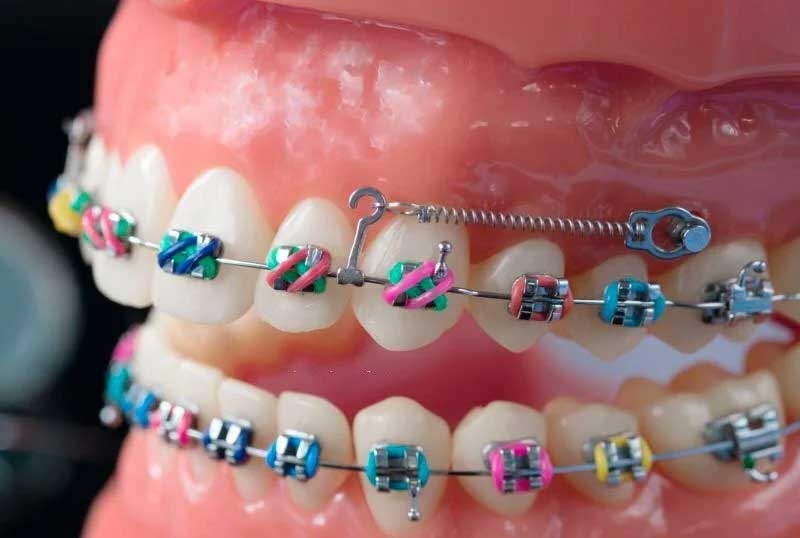 Một số lưu ý khi cắm vis niềng răng