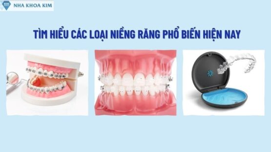 Tìm Hiểu Các Loại Niềng Răng Phổ Biến Hiện Nay