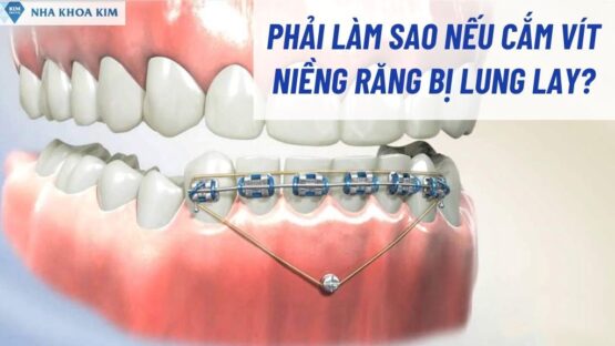 Phải Làm Sao Nếu Cắm Vít Niềng Răng Bị Lung Lay?