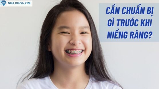 Cần Chuẩn Bị Gì Trước Khi Niềng Răng An Toàn Nhất?