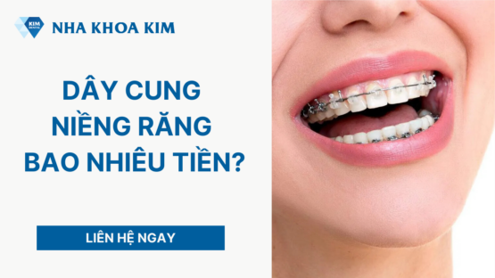 Dây cung niềng răng bao nhiêu tiền? Bảng giá chi tiết 2026