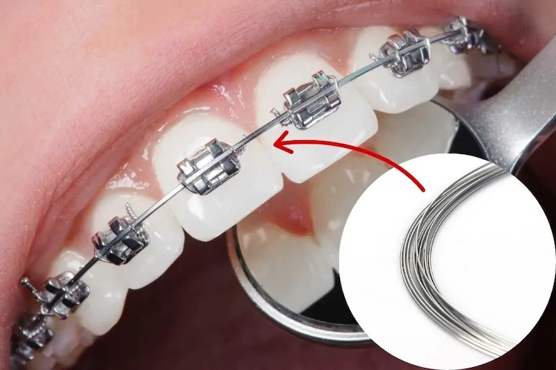 Dây cung niềng răng là một loại khí cụ chỉnh nha rất quan trọng