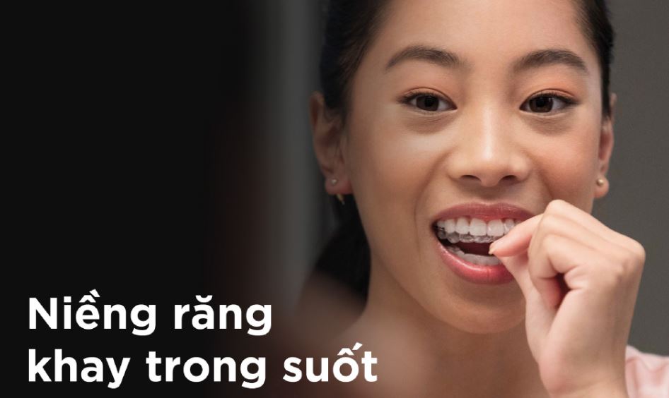 Tìm hiểu niềng răng hô là gì