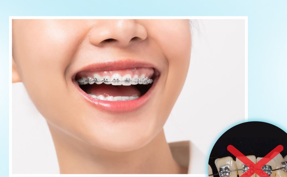 Trường hợp nên và không nên niềng răng hô khi mang thai