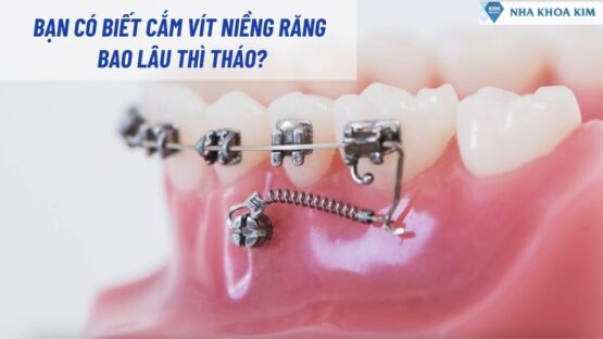 Bạn Có Biết Cắm Vít Niềng Răng Bao Lâu Thì Tháo?