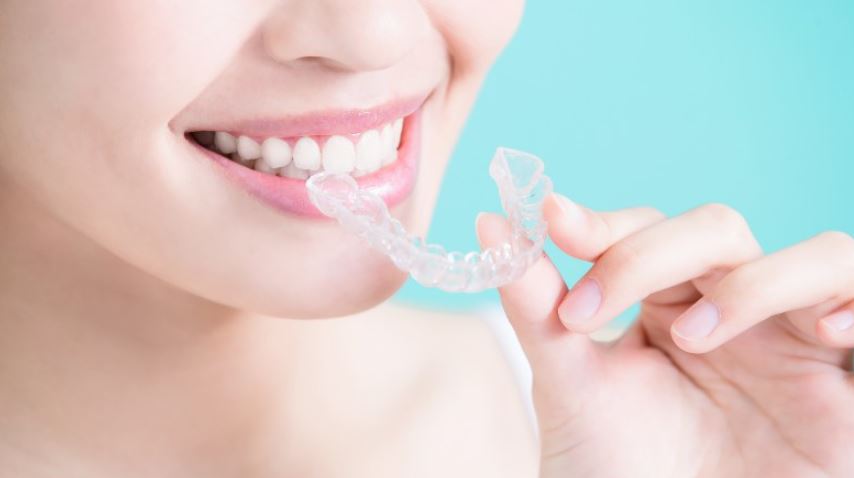 Ưu điểm khi niềng răng không cắm vít