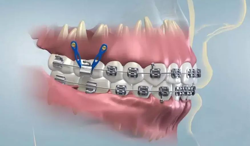 Vai trò quan trọng của minivis trong niềng răng