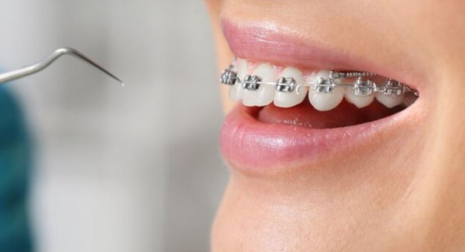 Tìm hiểu thời gian cắm vít niềng răng