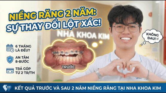 Kết quả trước và sau 2 năm Niềng Răng của Lâm Minh tại Nha Khoa Kim