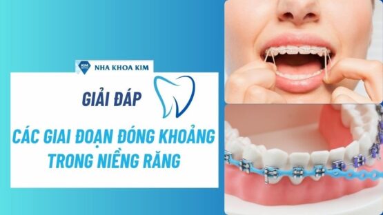 Giải Đáp Về Các Giai Đoạn Đóng Khoảng Trong Niềng Răng