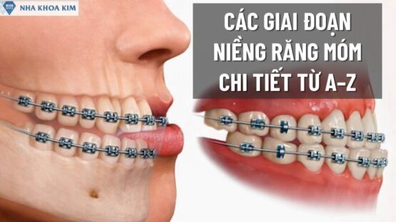 Tìm Hiểu Các Giai Đoạn Niềng Răng Móm Chi Tiết Từ A–Z