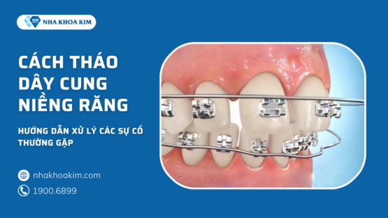 Cách tháo dây cung niềng răng và xử lý các sự cố thường gặp