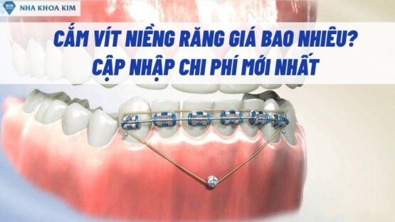Cắm Vít Niềng Răng Giá Bao Nhiêu? Cập Nhập Chi Phí Mới Nhất