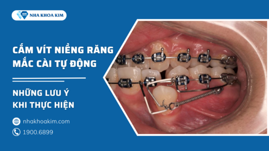 Cắm vít niềng răng mắc cài tự động là gì? Cần lưu ý gì?