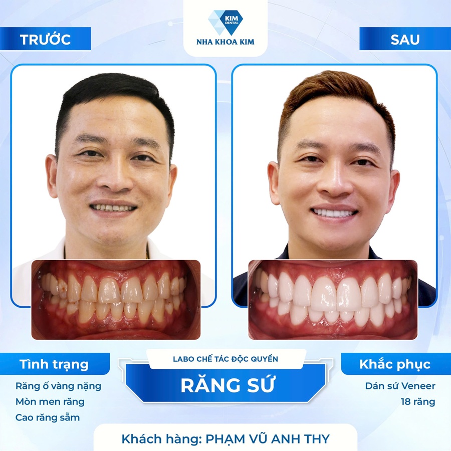 Hình ảnh khách hàng trước - sau khi tới với Nha Khoa Kim